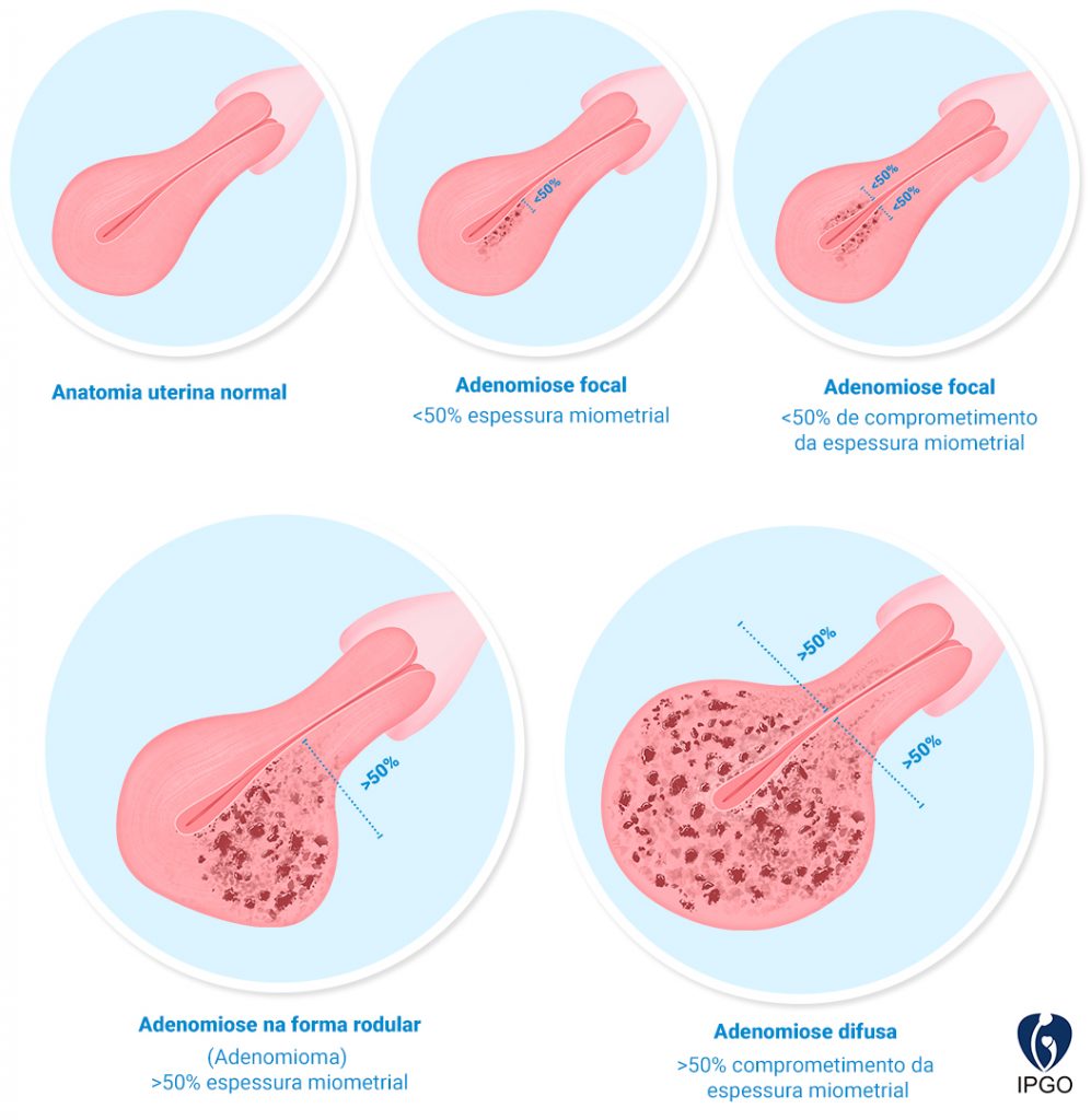 Adenomiose E Infertilidade Ipgo Centro De Medicina Reprodutiva