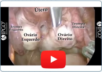 Ooforectomia esquerda laparoscópica com incisão única