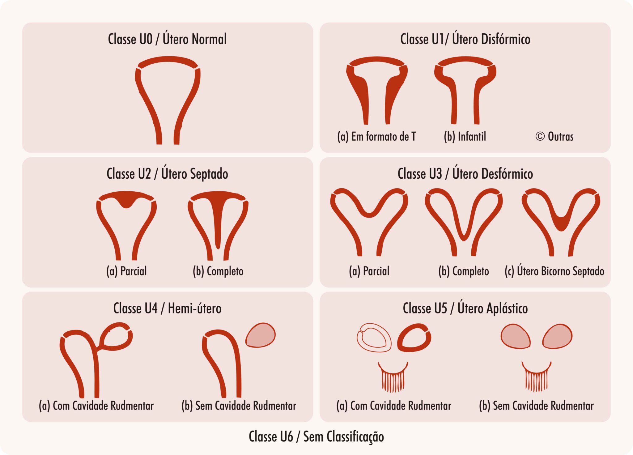 malforma-es-uterinas-ipgo