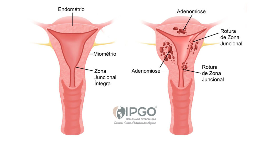 Coágulo menstrual ou aborto?