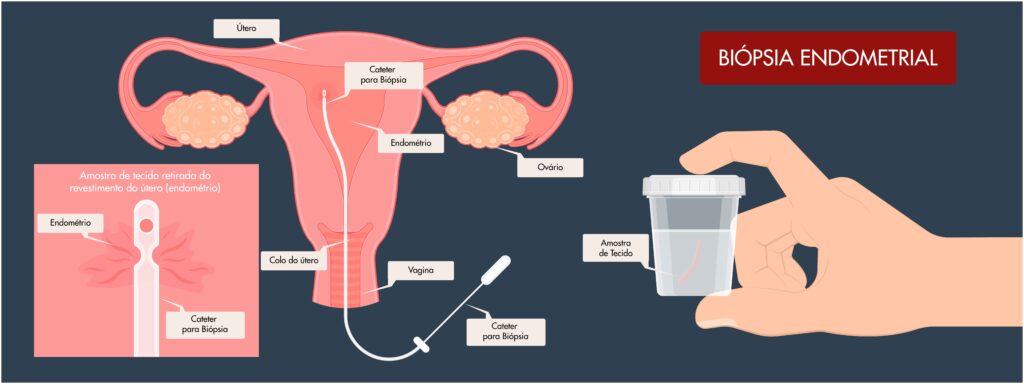 Passo a passo da biópsia endometrial - IPGO